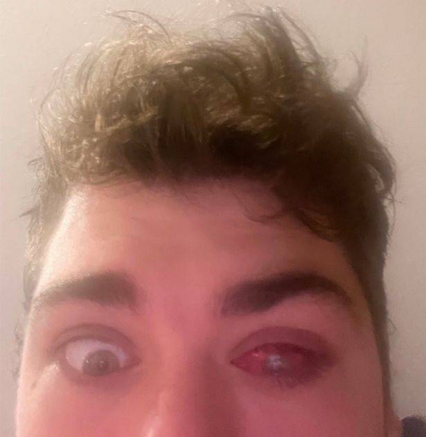 TrivDaily - Man fell asleep with contacts in and flesh eating parasites ate his eye 47 The parasite caused serious damage to his eye. Credit: Mike Krumholz