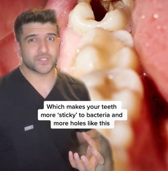 They're not great for your teeth. Credit: TikTok/@thelondondentist
