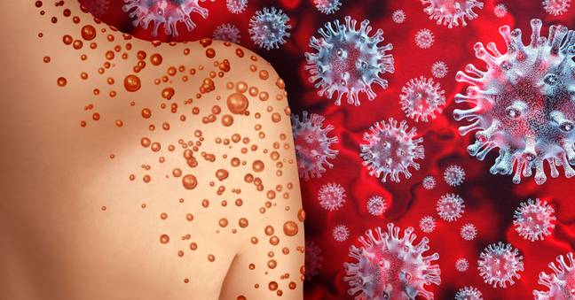 The virus can cause flu-like symptoms before a rash appears. Credit: Alamy