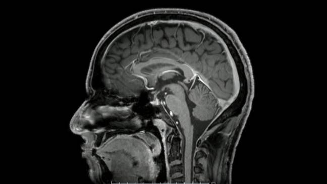 An MRI scan of a brain. Read more: mohamed abdelrazek / Alamy. 