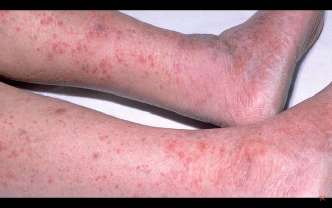 His skin started to develop a rash. Credit: New England Journal of Medicine. 