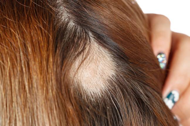 Researchers in the US have discovered a new drug for alopecia sufferers. Credit: Alamy