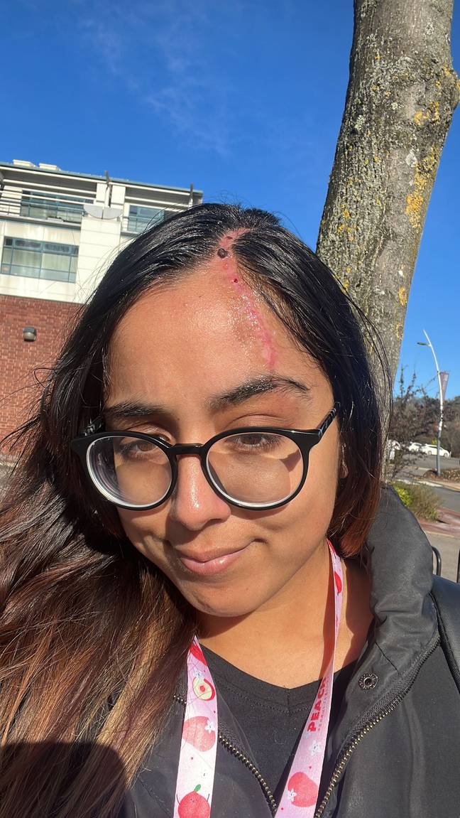 Woman left fearing she'd die when claw clip lodged in her scalp after