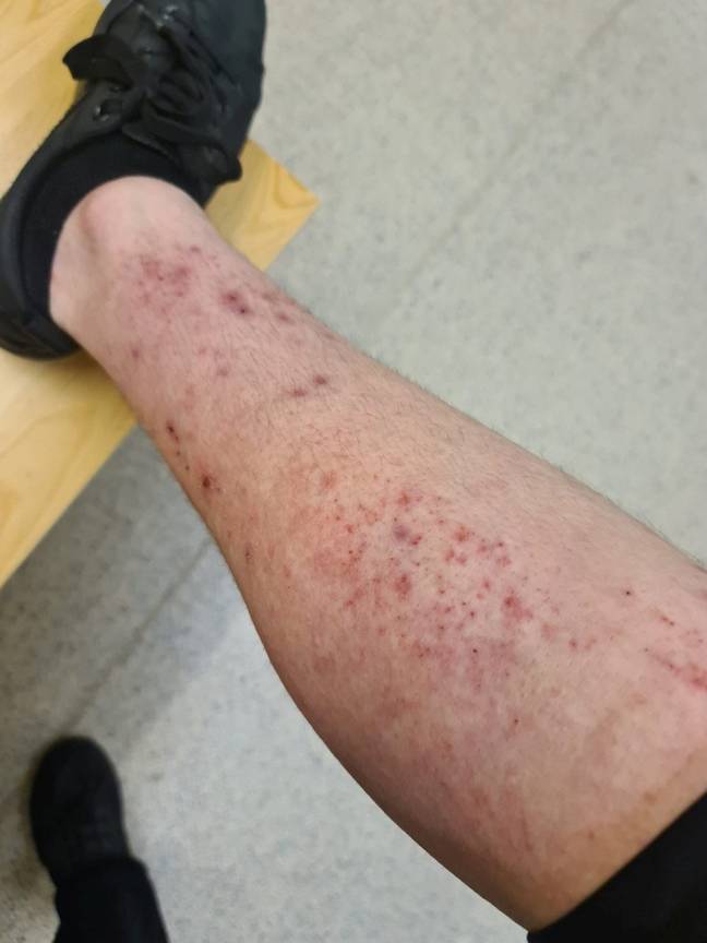 Antonia has suffered from eczema since she was a baby. Credit: SWNS
