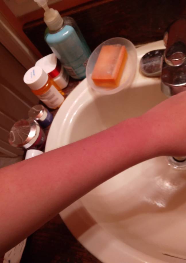 Sadie breaks out in hives and her skin flares up when her skin touches water. Credit: PA Real Life