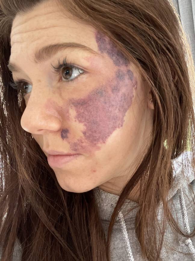 Emily was bullied at school over the birthmark (Credit: Kennedy News and Media)