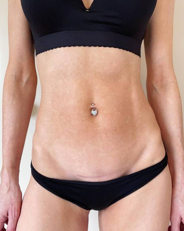 Kate Lawler shared a picture of her c-section scar. (Credit: thekatelawler/Instagram)