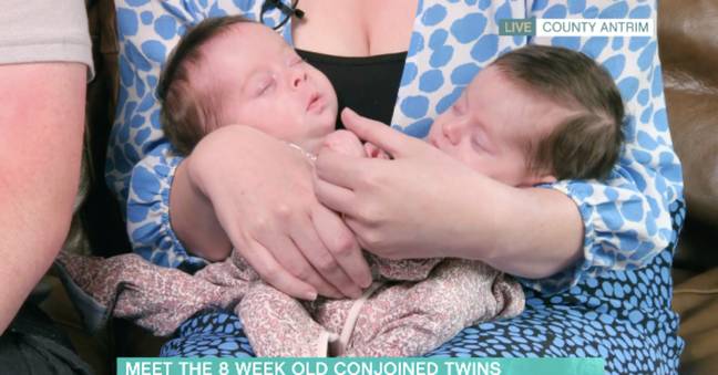 Conjoined twins Annabelle and Isabelle. (Credit: ITV)