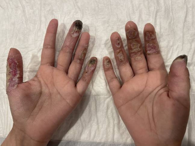 Shannyn's hands began to blister and burn following the surgery. Credit: Kennedy News and Media