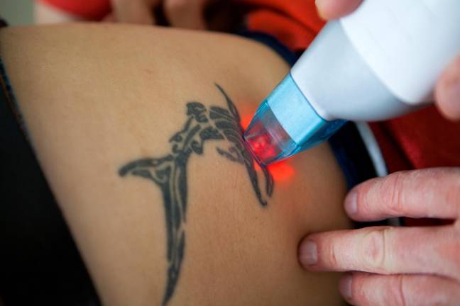 The laser is only one aspect of the tattoo removal process. Credit: BSIP SA / Alamy Stock Photo