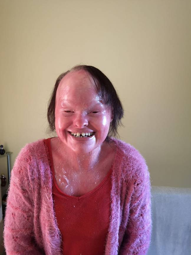 Hannah Betts, who had rare genetic condition Harlequin ichthyosis, has passed away at the age of 32. Credit: SWNS