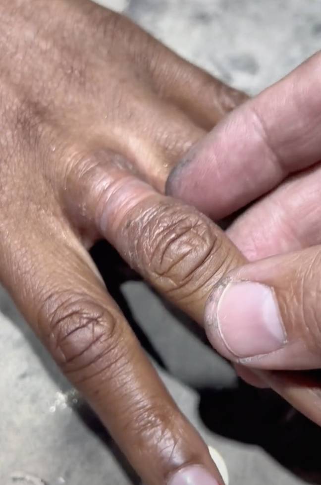 Ring Rips Off Finger Woman gets rings removed from her finger after they were stuck for 15 years