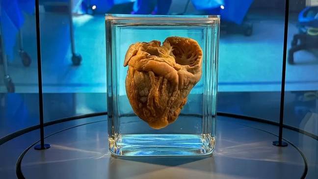 Jennifer's heart on display at the Hunterian Museum in London. Credit: Tom Evans