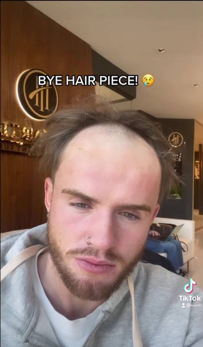 Kegs shed his hairpiece for a more permanent hair transplant. Credit: kegs97/TikTok