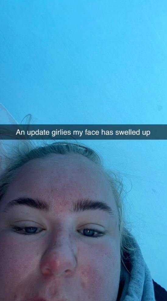 Eva suffered from blisters after just one hour in the sun. Credit: TikTok/@evajones__