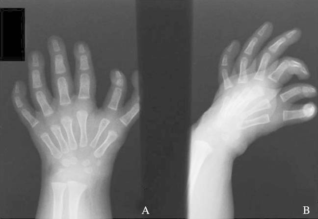 Dimelia Rare ‘mirror hand’ syndrome causes one hand to be completely symmetrical