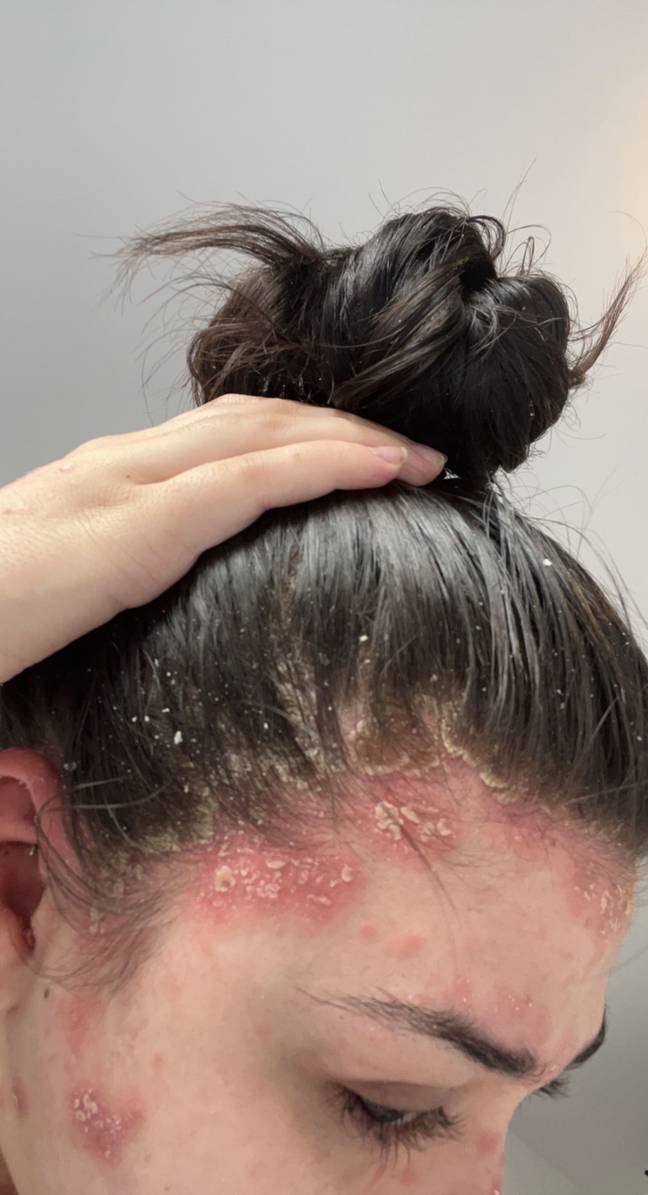 Woman Claims Sharing Vape With Friends Triggered 'Red Raw' Skin Condition