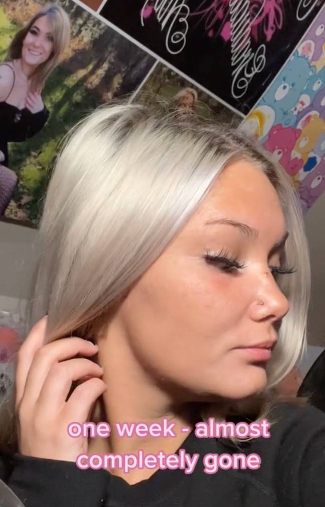 After one week, the TikTok user claimed her acne was ‘almost completely gone’. Credit: TikTok/@barbiedreamz