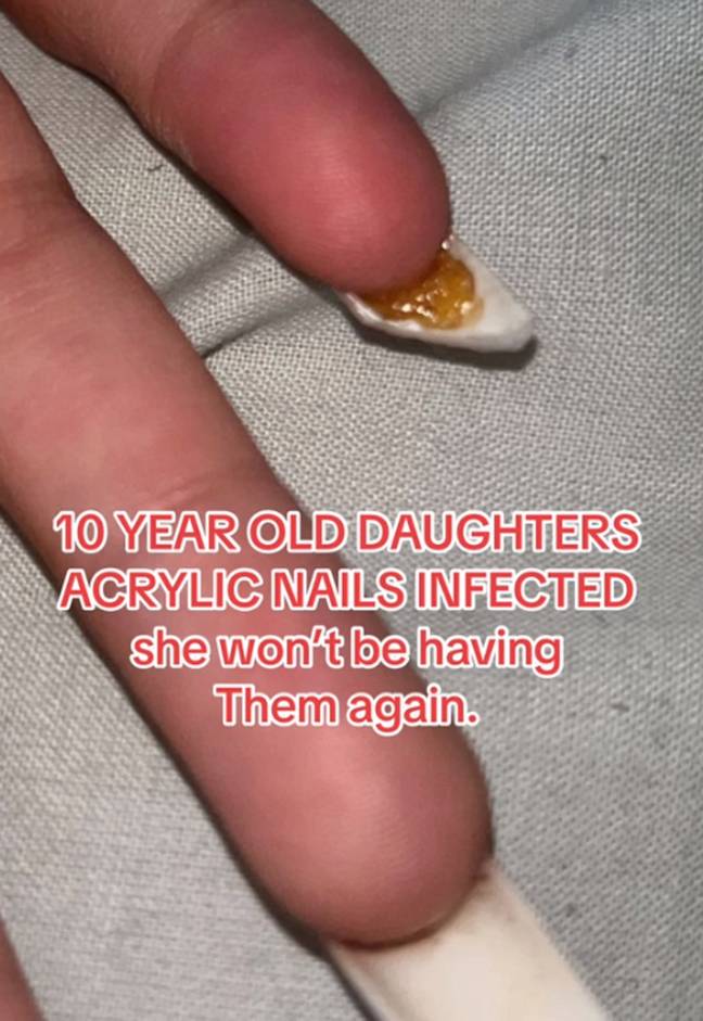 The nails became infected and caused the girl a lot of pain. Credit: TikTok/@itsmebadmom