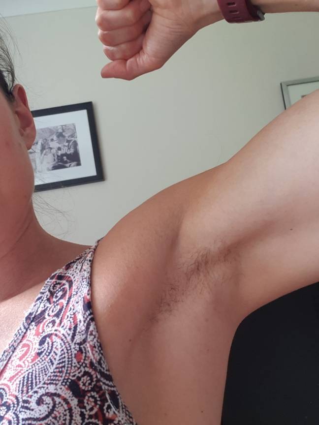 &quot;I don't really care what or how it looks. It's more about that I don't have the rash and the itchiness under my arms,&quot; Becky said. Credit: Becky Derbyshire.