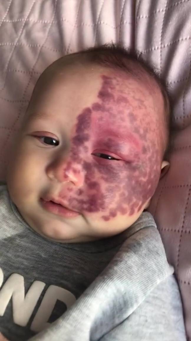 Kingsley was born with a port wine stain birthmark. Credit: Jam Press