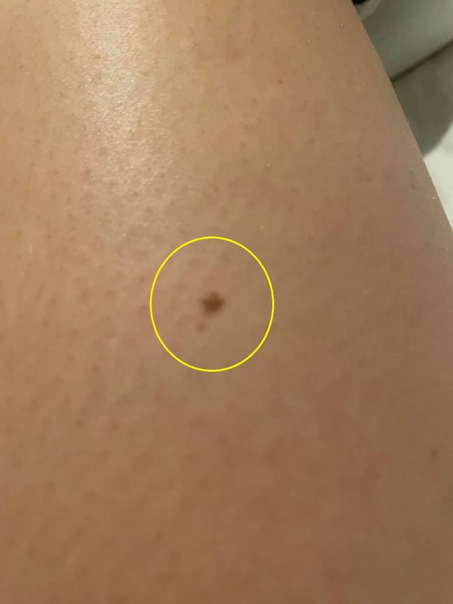 Paris noticed a tiny freckle on her leg (Credit: Kennedy News and Media)