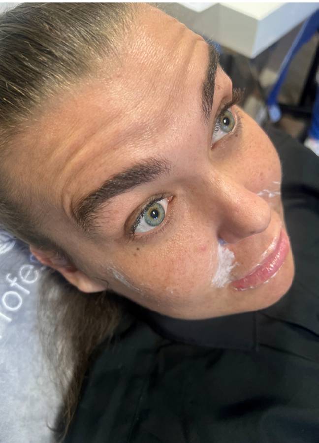 The woman, who called herself Charlotte, had Botox injections and lip filler and is seen here with numbing cream on her upper lip. Credit: SWNS