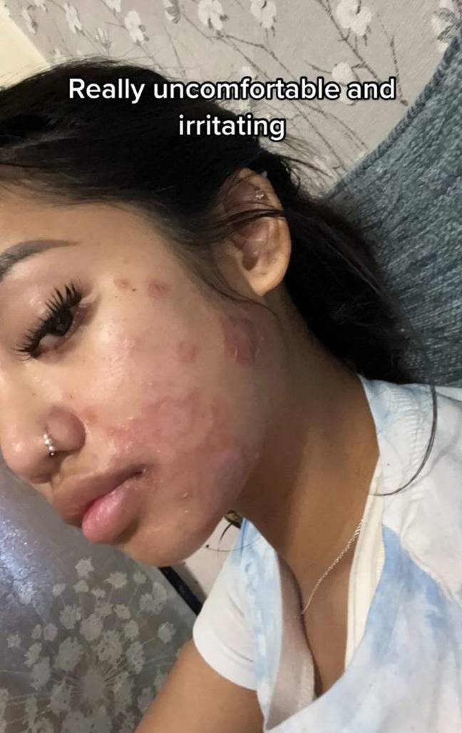 Louaira Dela Cruz shared videos of her rashes to TikTok. Credit: TikTok/@louaira