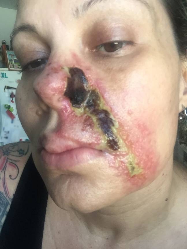She said her face started 'burning and melting'. Credit: Kennedy News and Media