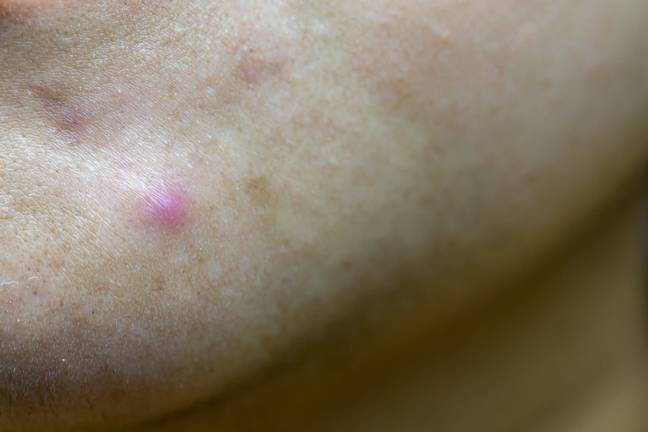 Cystic spots should be treated as opposed to squeezed. Credit: Getty/kckate16