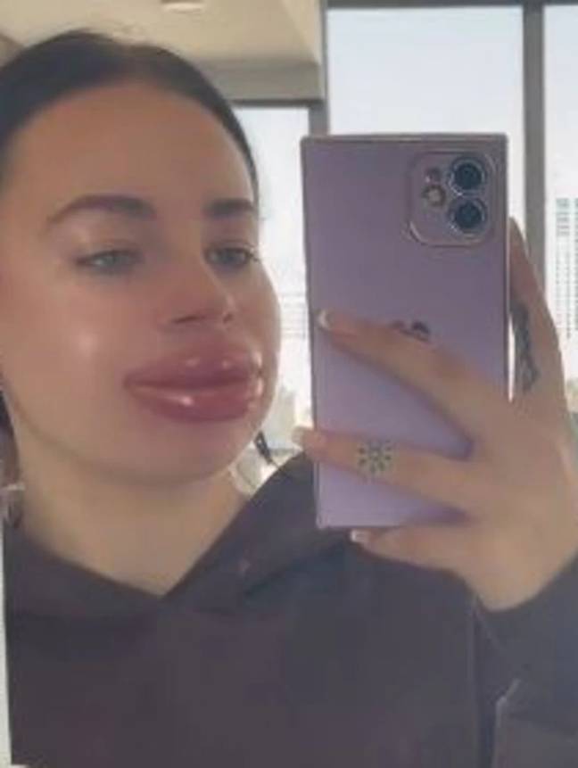 Jessica Burko was left with painfully swollen lips after having a free treatment as part of a giveaway. Credit: TikTok/@jessicacaileyburko