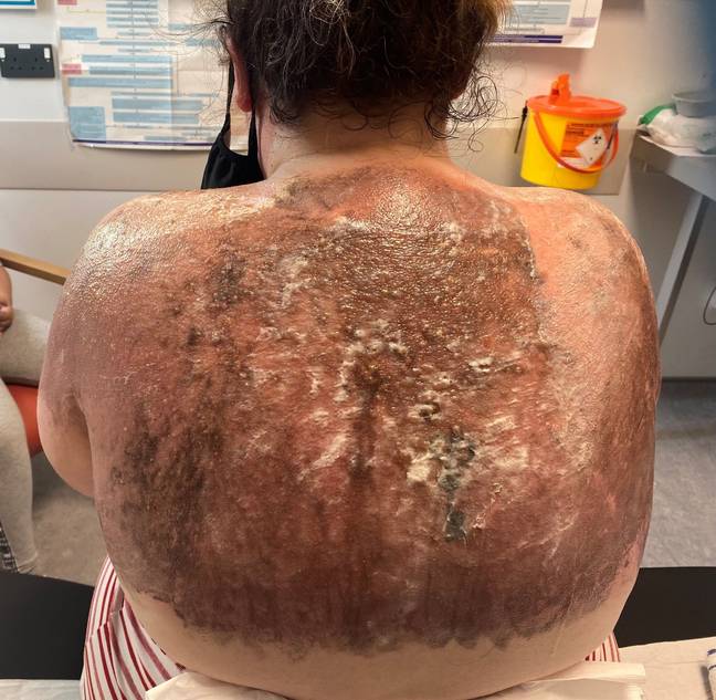 Danielle has been left with a horrific burn covering her upper back (Credit: Kennedy)