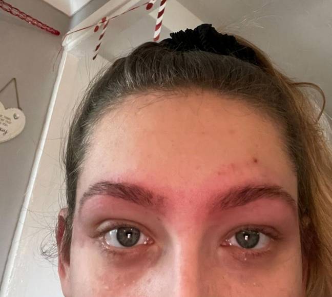 Megan began to worry when she started experiencing an intense burning sensation across her brows and face. Credit: SWNS