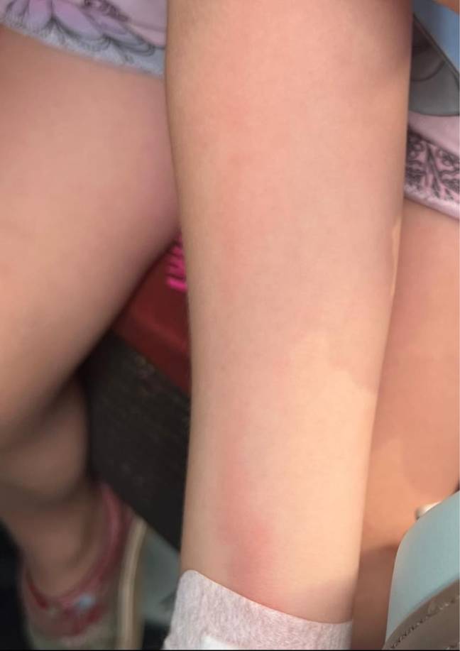 The mum noticed something odd when she saw a red line growing up her child's arm. Credit: Facebook/Family Lowdown