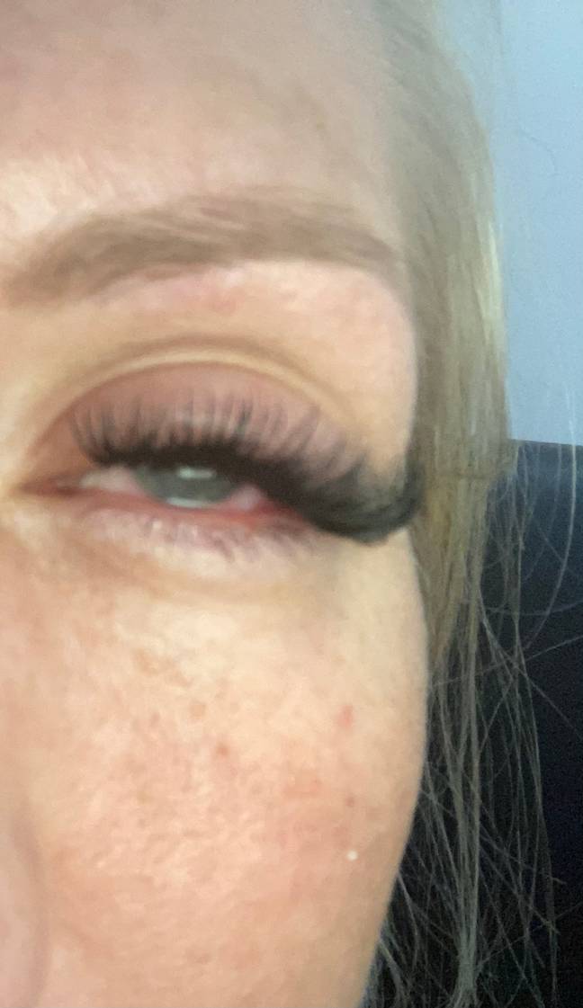 A&amp;E doctors told her to immediately have the lashes removed but the beautician refused to help her or refund her (Credit: Triangle News)