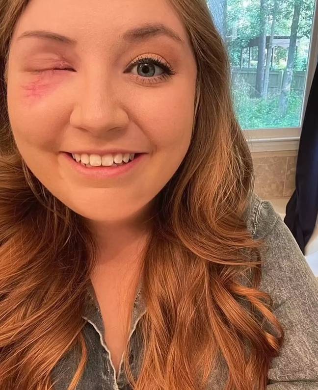 Hannah Oliver lost her eye in a 'minor car accident' back in 2021. Credit: Instagram/@hannahnoliver