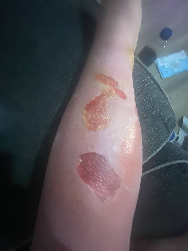 Laura was told she had third-degree burns (Credit: Kennedy)