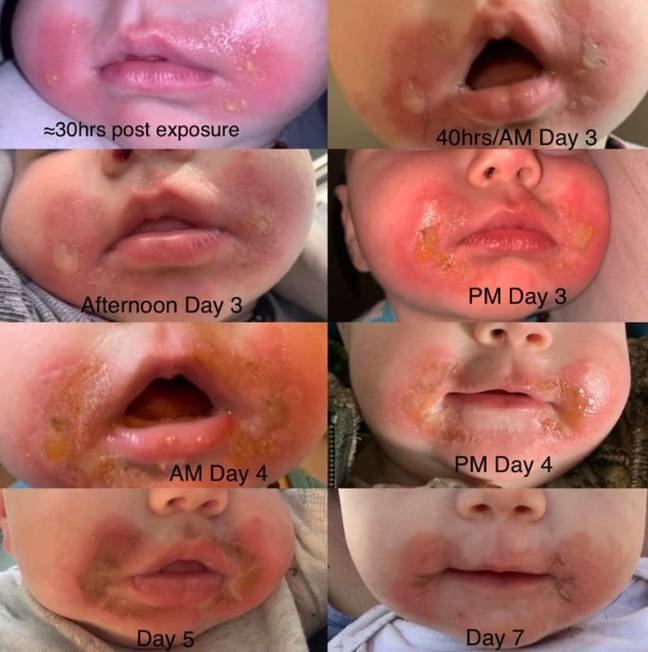 Reanna Bendzak woke up to find her daughter had a rash around her mouth. Credit: Facebook/ Reanna Bendzak