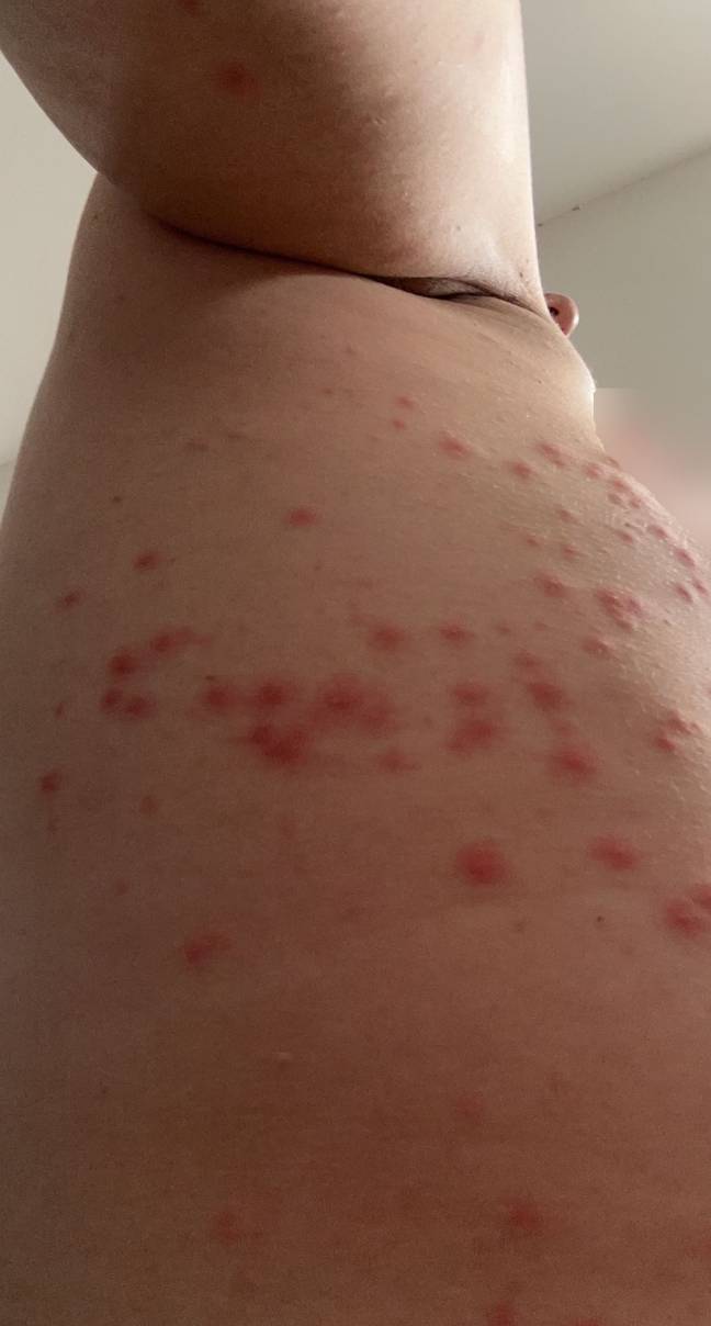 She said she was left with 150 bed bug bites. Credit: Kennedy News