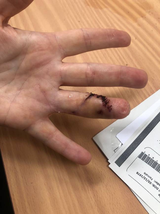Medics spent six hours reattaching the finger. Credit: SWNS