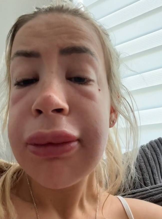 Courtney's lips and whole face swelled before she headed to hospital. Credit: TikTok/@courtneyb24x