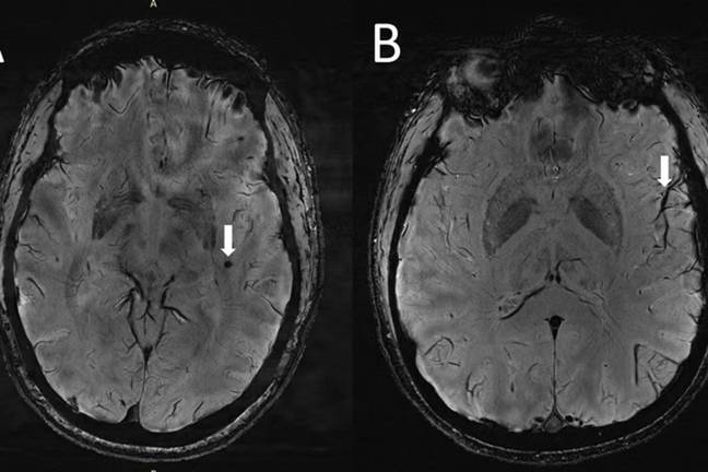 That spot on the left is a cranial microbleed, while the thing on the right is an example of an enlarged perivascular space. Credit: RSNA and Wilson Xu