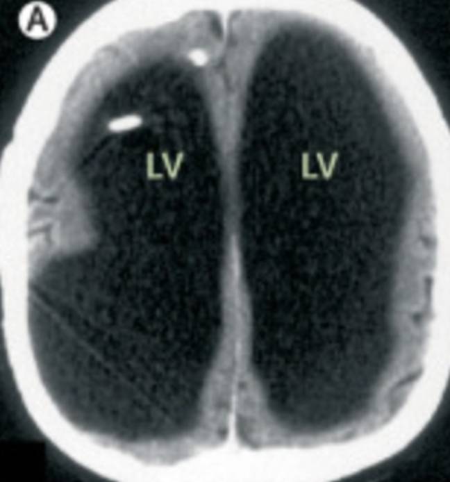 The man who survived with almost no brain at all