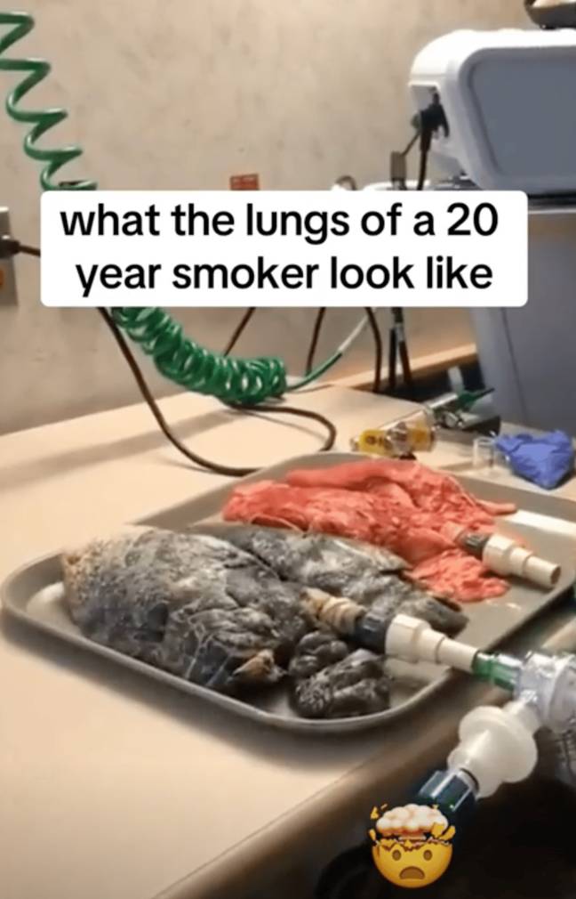The nurse showed the horrifying difference between a smoker's set of lungs and a non-smoker's. Credit: Facebook/Amanda Eller