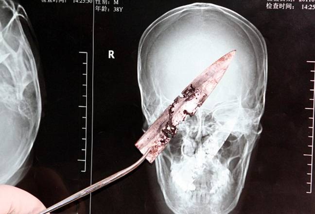 The blade in Li's head had begun to corrode. Credits: Caters News Agency