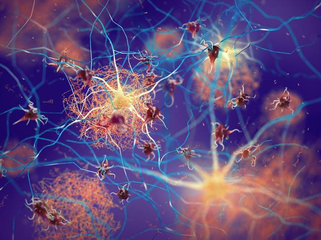 Beta-amyloid protein disrupting nerve cells function in a brain with Alzheimer's Disease. Credit: nobeastsofierce Science / Alamy