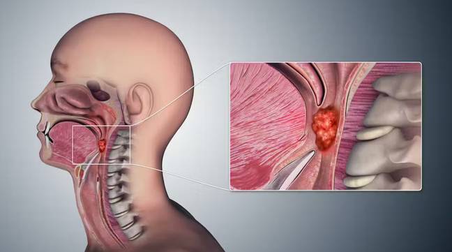 A scientist has revealed that oral sex is now the main cause of throat cancer. Credit: Scientific Animations/Wikimedia Commons