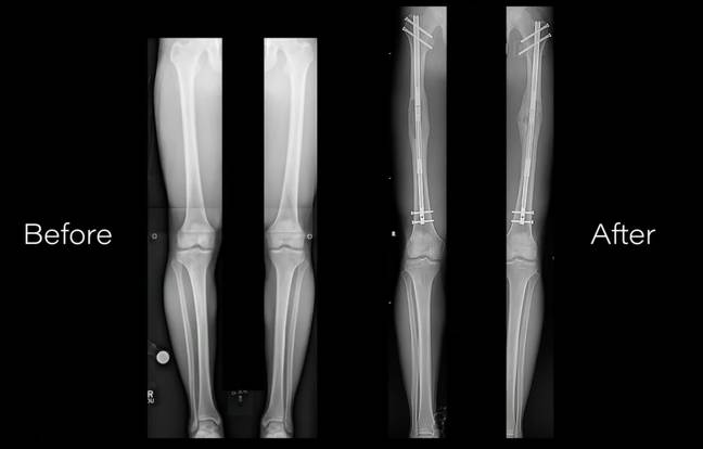 Leg Resizer Leg lengthening procedure causes controversy on social media