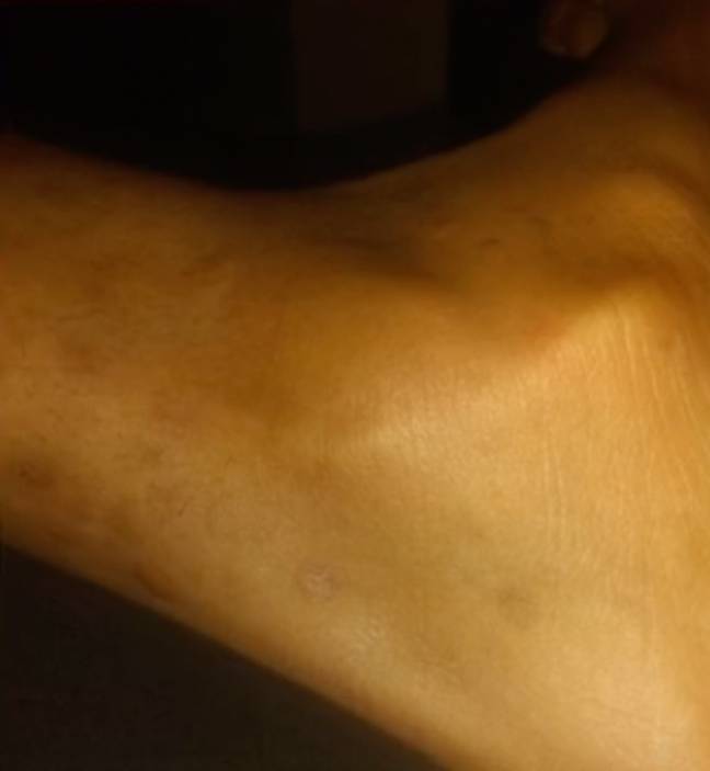 Here other daughter had marks on her ankle. Credit: @tateasa/TikTok