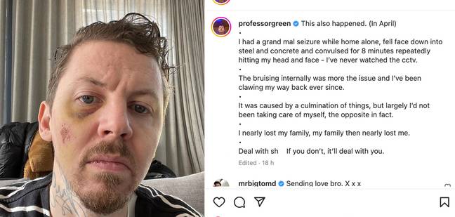 Green showed his bruised face on Instagram. Credit: @professorgreen/Instagram
